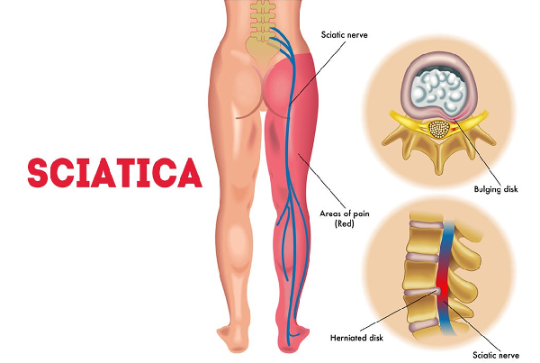 Banish Sciatica Pain with MSK Centre in Waterloo , ON